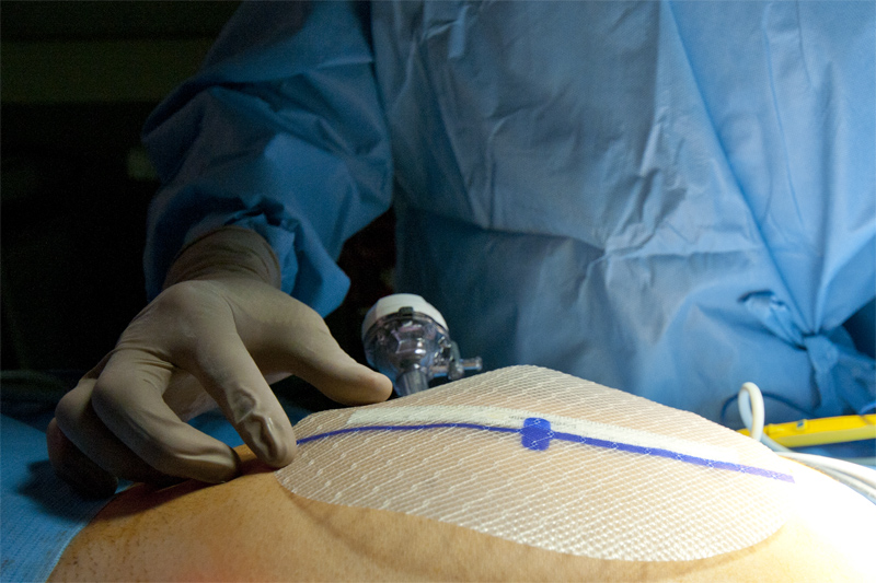 Surgical Mesh Market Comprehensive Overview of Growth Trends and Market ...