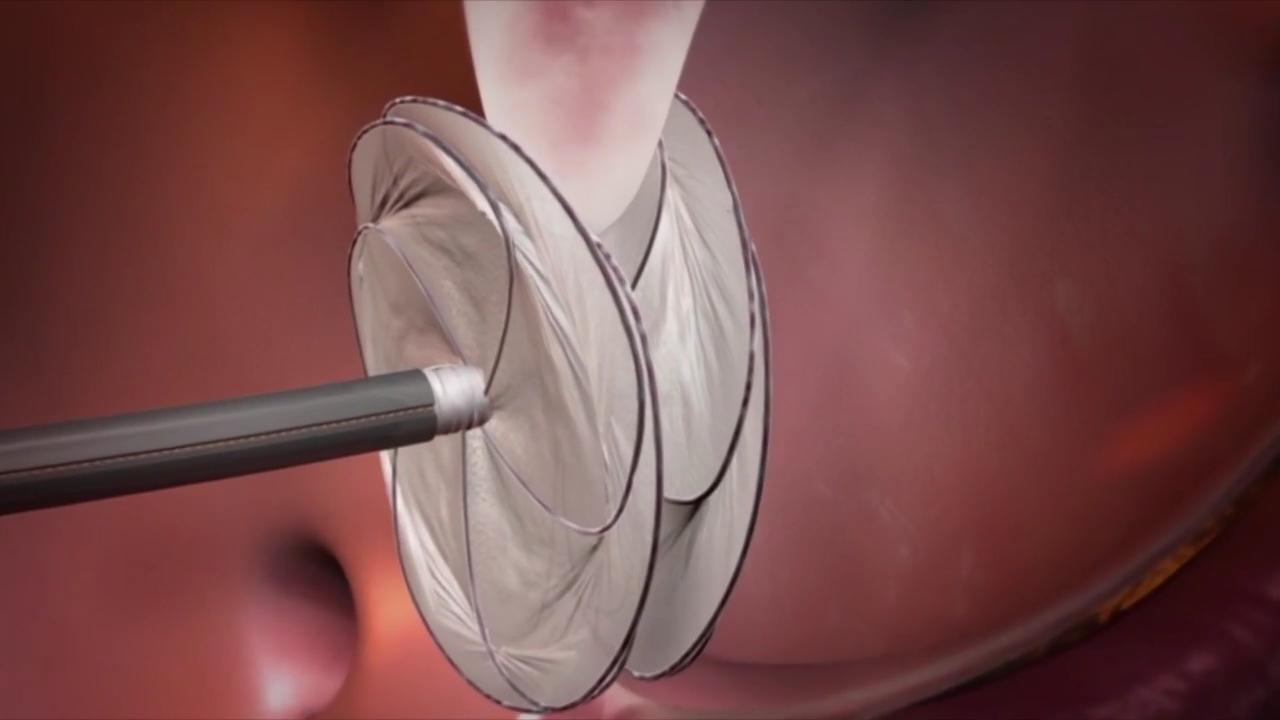 Heart Closure Devices Market Analysis & Forecast (2025-2035): Trends in ...